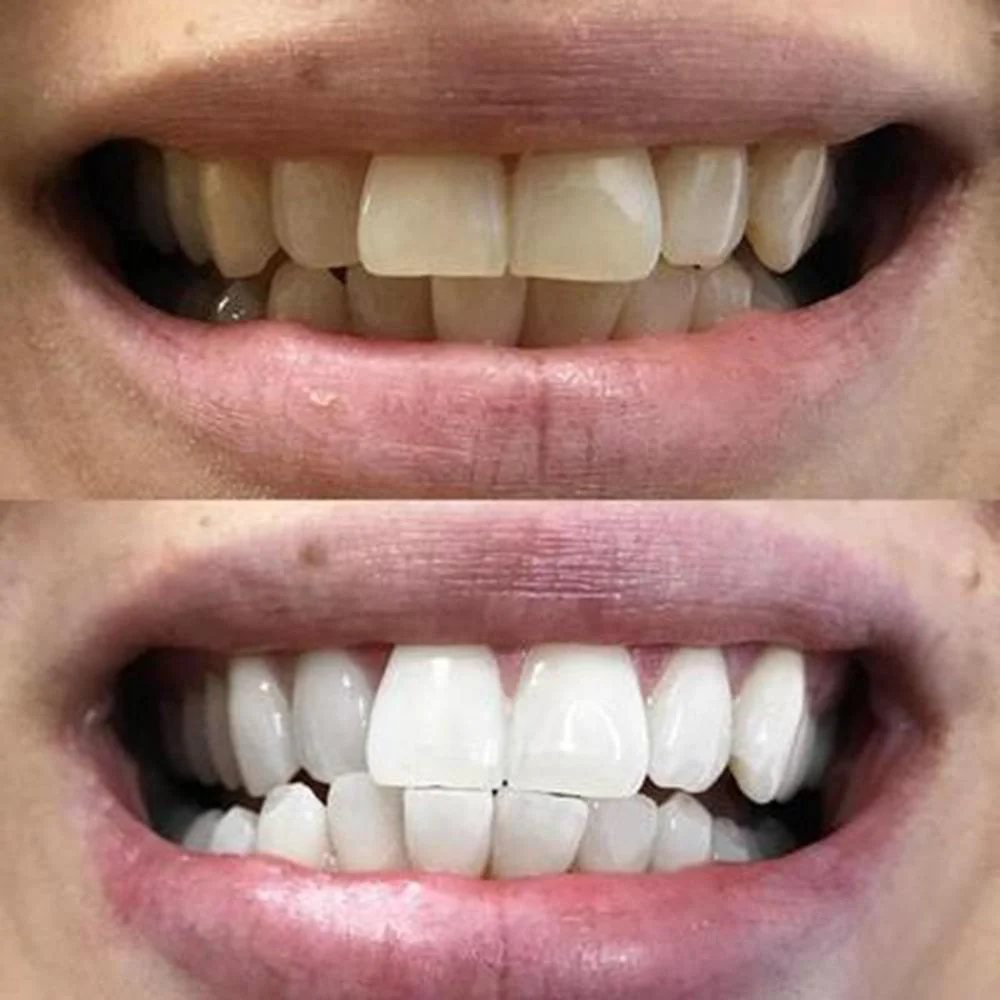 Bandes de Blanchiment Dentaire - Image 8